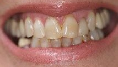 Close up of imperfect teeth before veneers and Lumineers