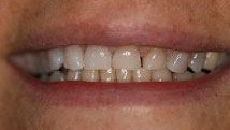 Close up of imperfect teeth before veneers and Lumineers