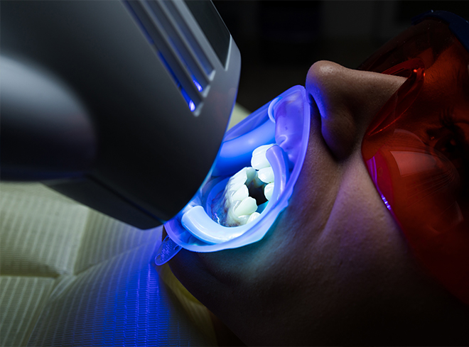 Close up of person getting professional teeth whitening in dental office
