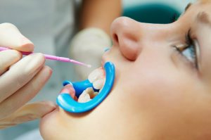 A patient receiving a fluoride treatment.