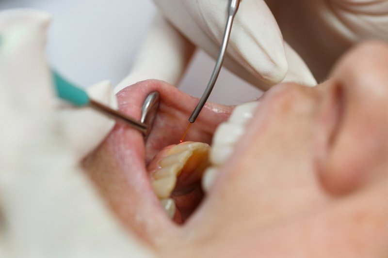 Person receiving soft tissue laser therapy for a gummy smile